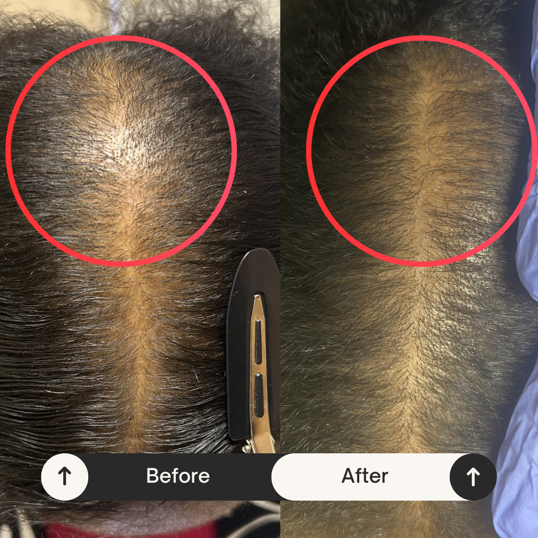 Healing Strands LLC | Hair Transplant | Hueytown, AL