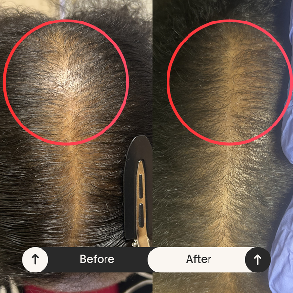 Healing Strands LLC | Hair Transplant | Hueytown, AL