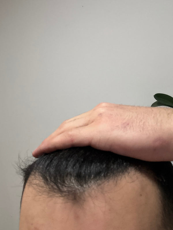 Prp Saç Tedavisi İzmir | Ossi Hair | İzmir Saç Ekimi | Mezoterapi İzmir | PRP İzmir