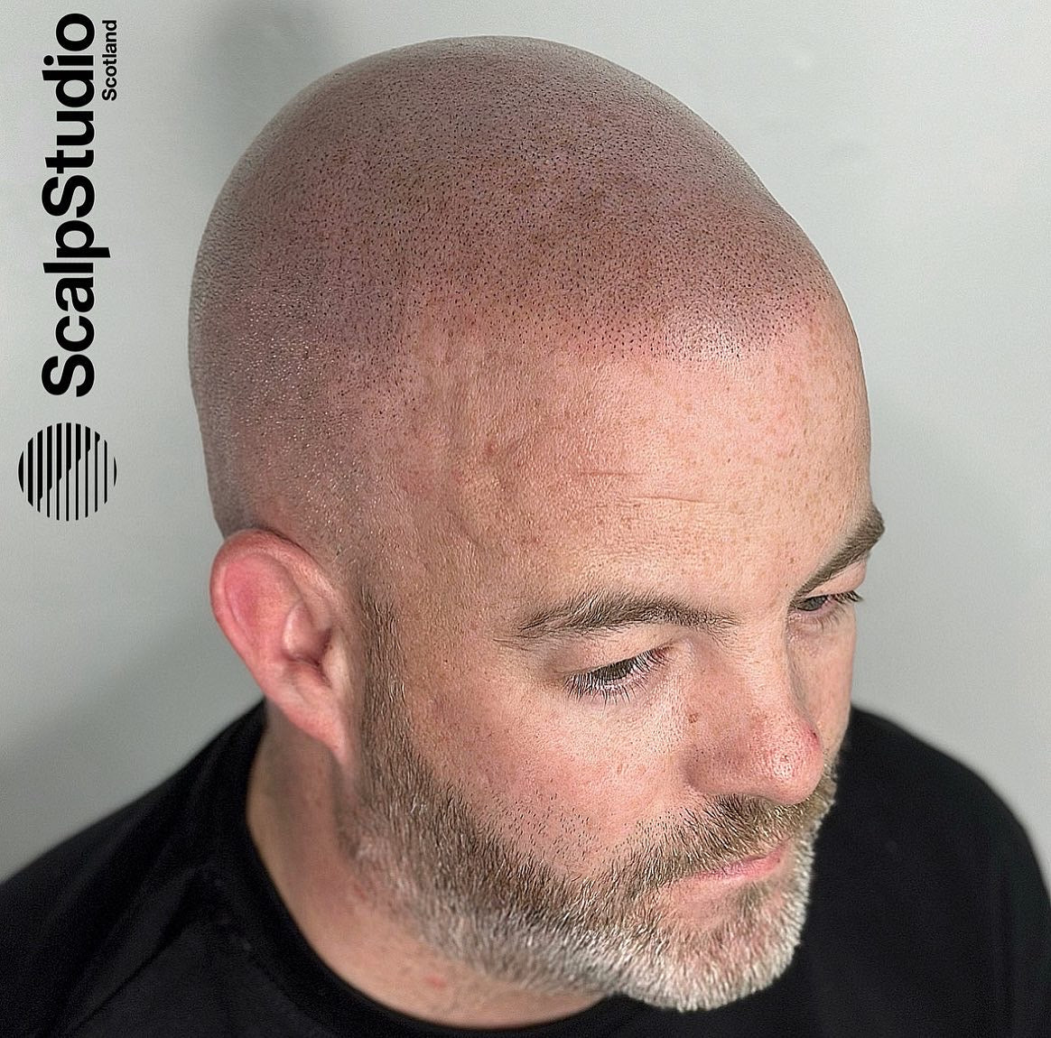 Scalp Studio | Scalp Micropigmentation Glasgow - Hair Transplant clinic in Glasgow, United Kingdom