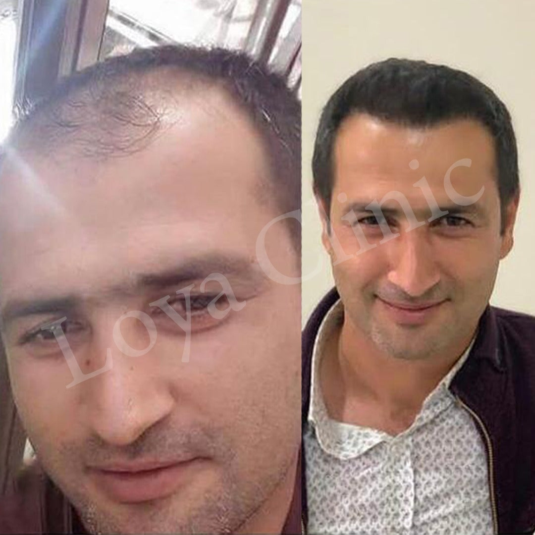 İzmir Saç Ekim Merkezi | Loya Clinic | Fue saç ekimi | İzmir saç PRP ve Mezoterapi | Sakal ekimi | Kaş ekimi — Dr.Visor photo 5