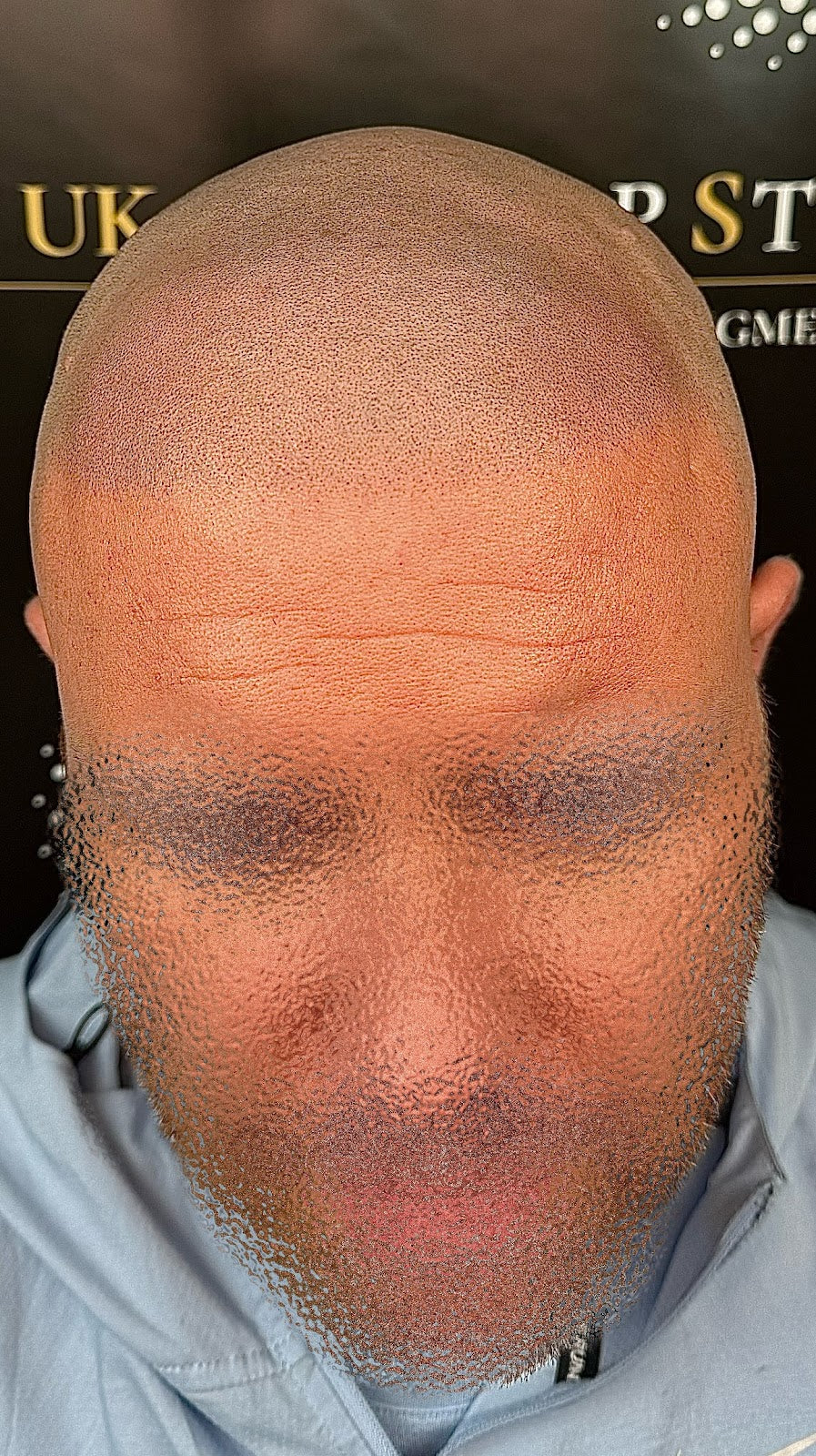 Scalp Styles UK - Hair Transplant clinic in Birkenhead, United Kingdom