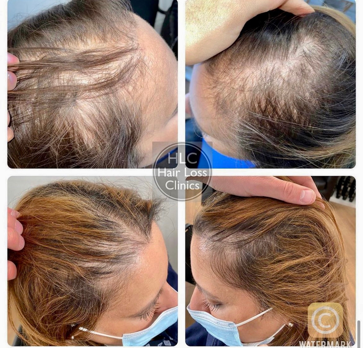Leeds Hair Loss Clinic — photo 4