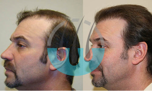 Hair Transplant London I Micro Fue Turkey - Hair Transplant clinic in Purley CR8 2AF, United Kingdom