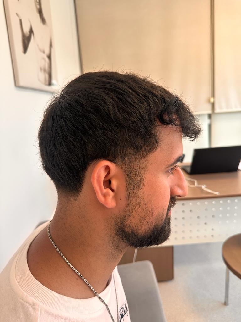 Bilyana Hair Transplant — Dr.Visor photo 5