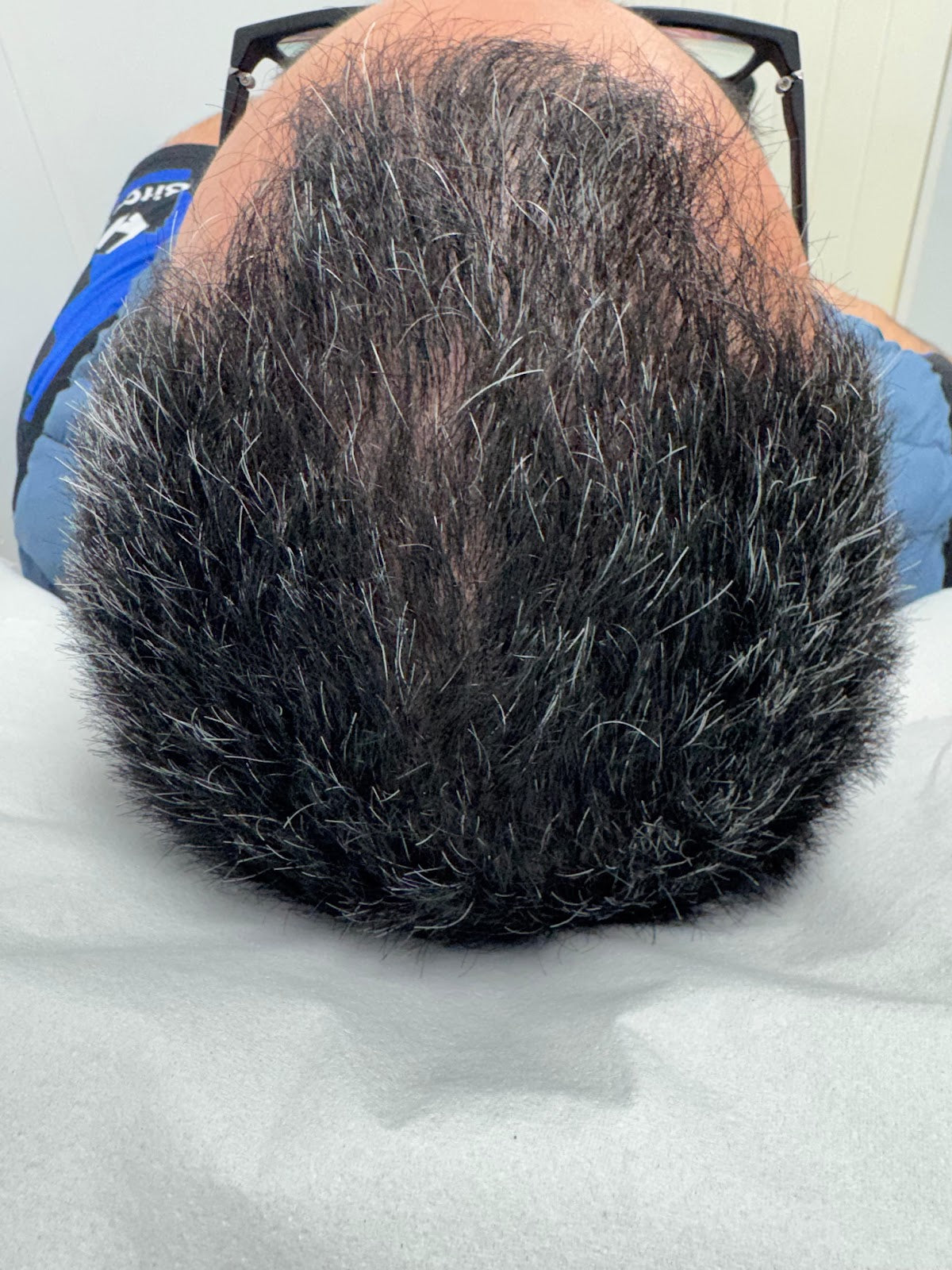 PRP Hair And Skin Clinic — Hair Transplant Clinic in Birmingham