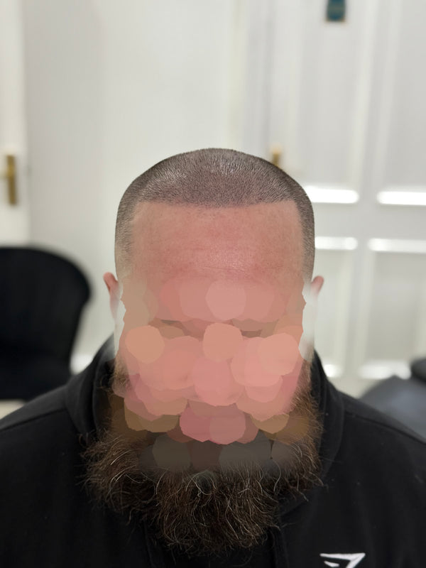 The Scalp Revival Clinic | Hair Transplant | Huddersfield