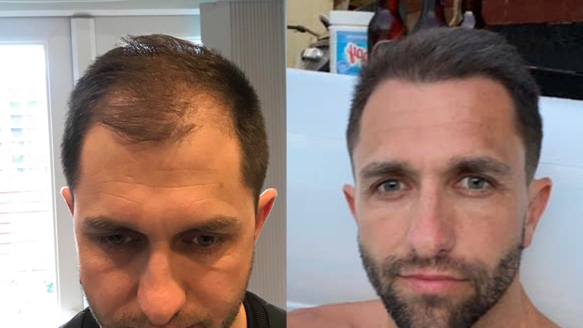 Hair Transplant Solutions — photo 2
