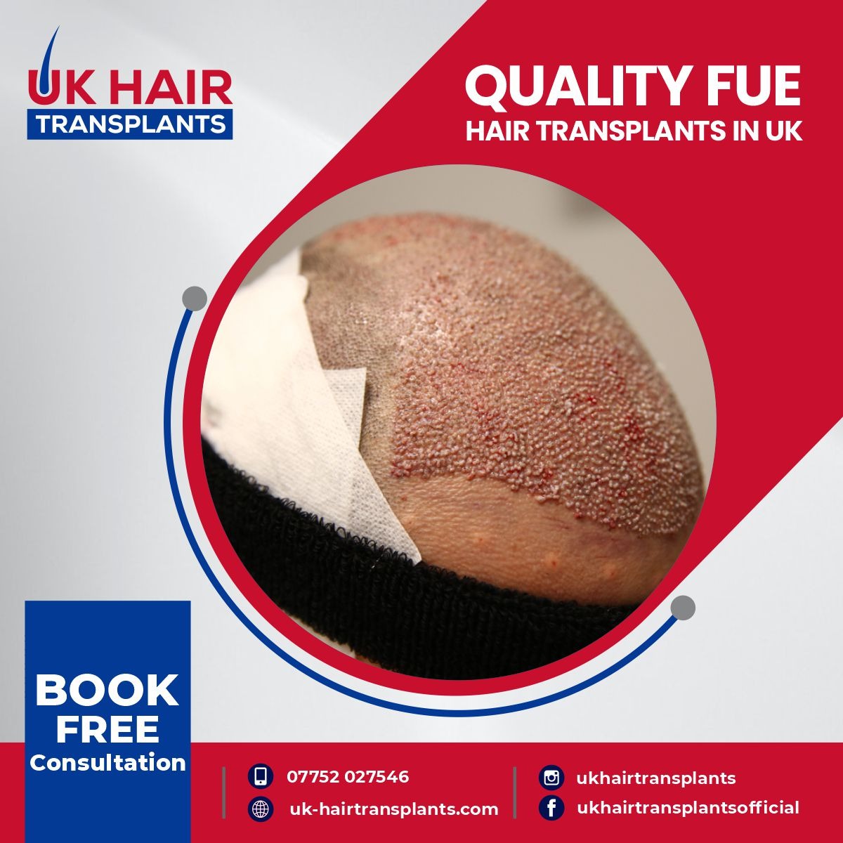 UK Hair Transplants UKHT Birmingham — photo 5