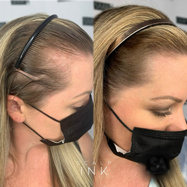 Scalp Ink LV | Hair Transplant | Las Vegas, NV