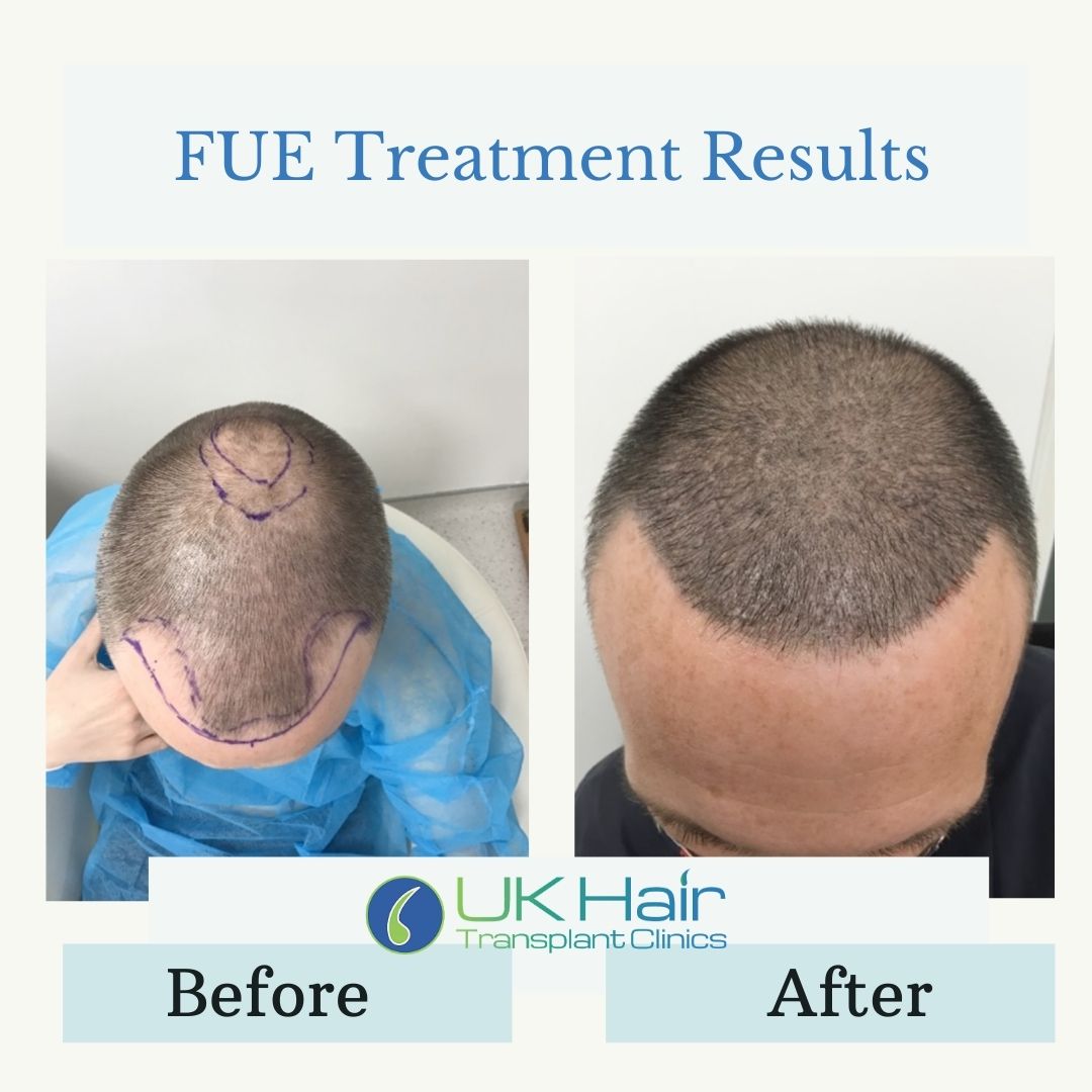 UK Hair Transplant Clinics Manchester — photo 4