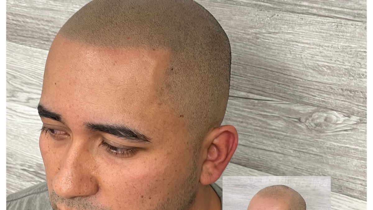 Scalp Co. Scalp Micropigmentation | Hair Transplant | Parker, CO