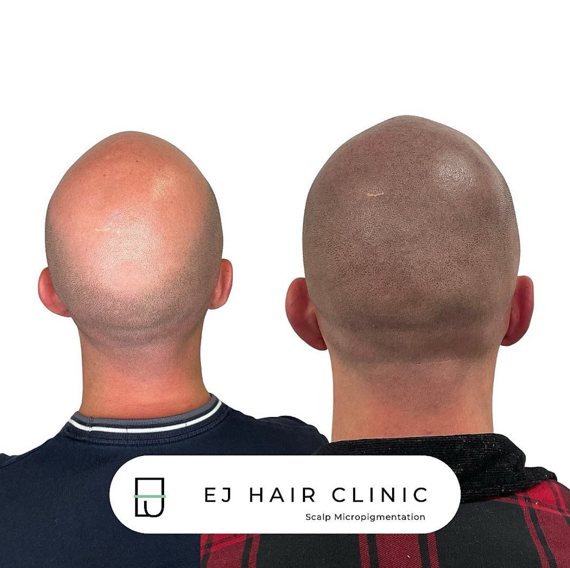 EJ Hair Clinic SMP - Hair Transplant clinic in Bristol, United Kingdom
