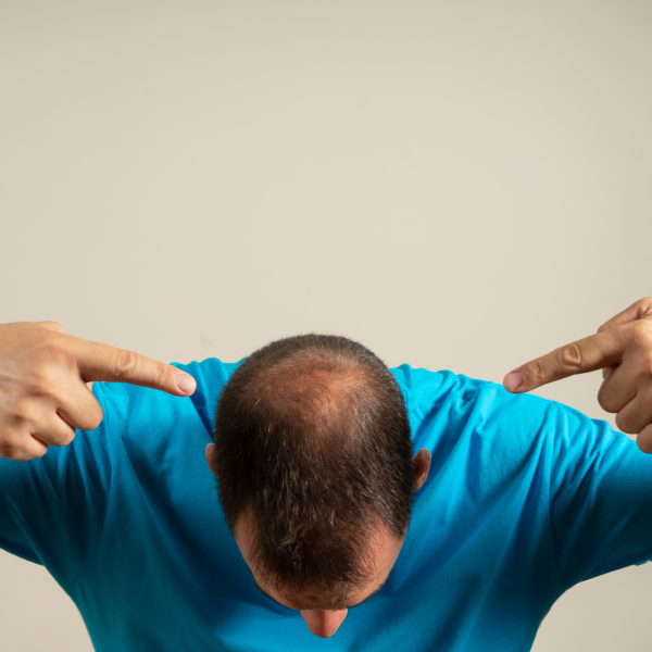 Shapiro Medical Group | Hair Transplant | Bloomington, MN