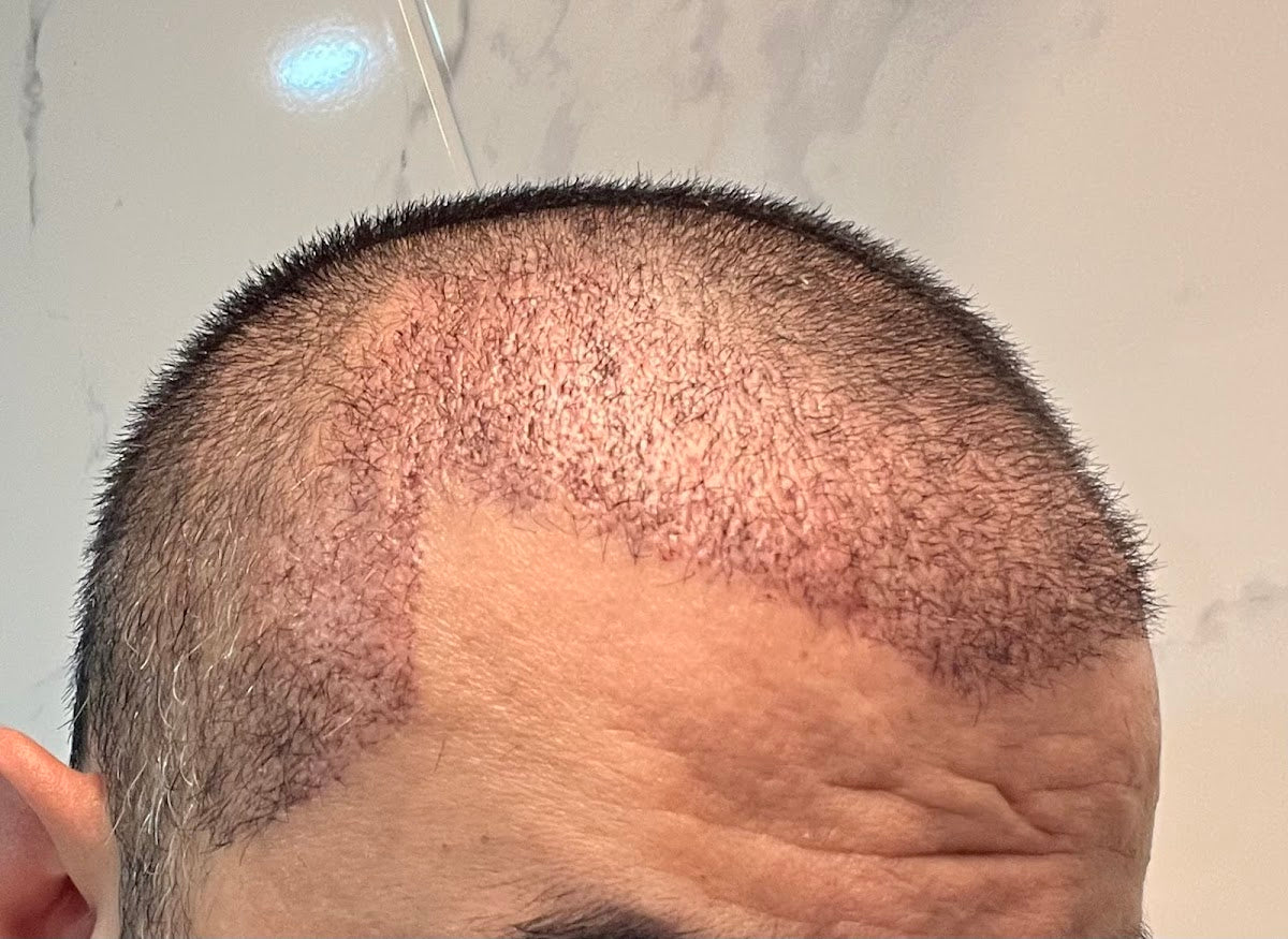 Smile Hair Clinic Hair Transplant Turkey Istanbul — Dr.Visor photo 5