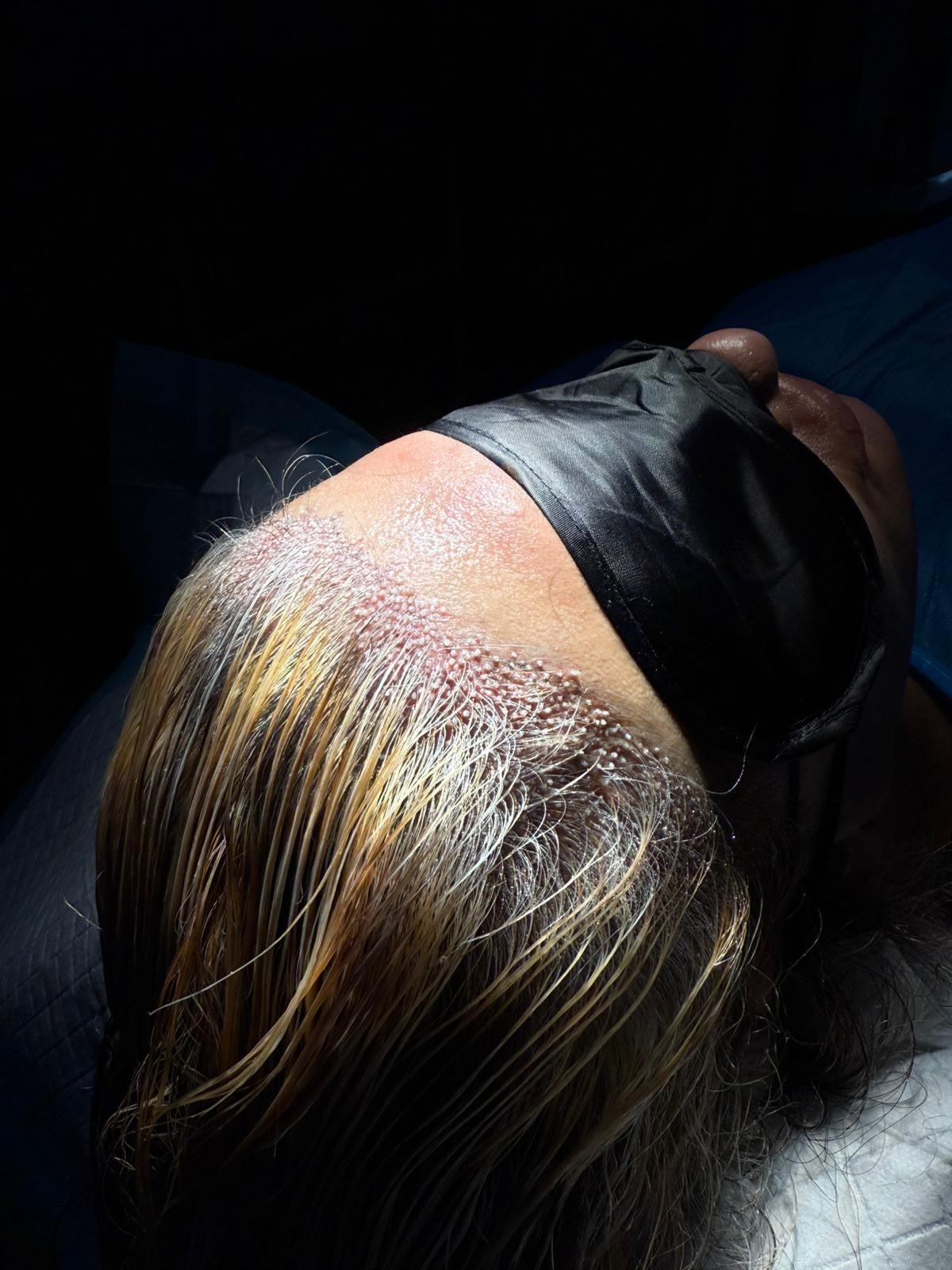 Robotic DHI UK Hair Transplant — photo 2