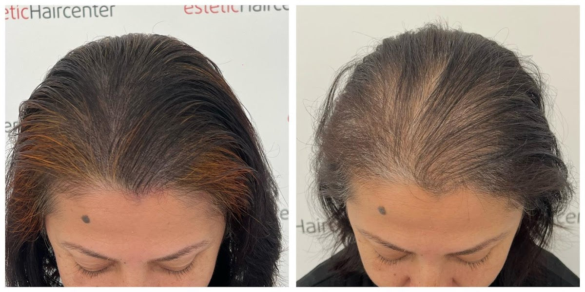 Estetichaircenter Saç Ekimi Saç Simülasyonu Bursa — Dr.Visor photo 5