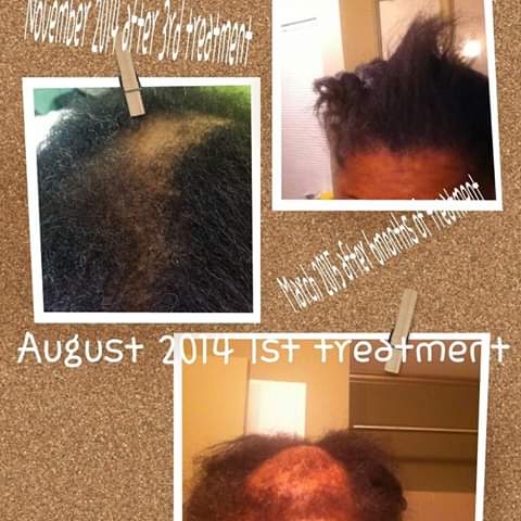 SEB Swarthy Everlasting Beauty Natural Collection, LLC | Hair Transplant | Sherwood, AR