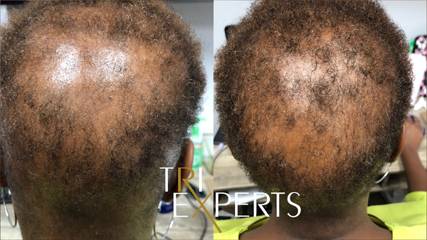 TriExperts Hair Center | Hair Transplant | Pearl, MS