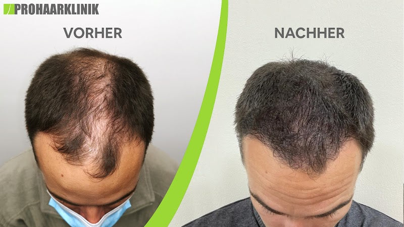 Haartransplantation Wien Prohaarklinik | Hair Transplant | 1010 Wien