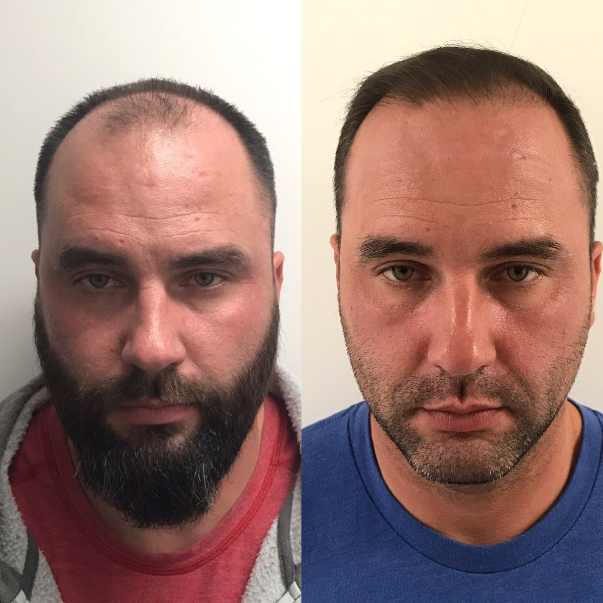 Hair By Robotics | Hair Transplant | Wichita, KS