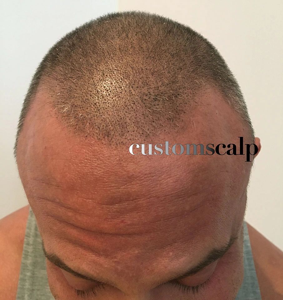 CustomScalp | Hair Transplant | Milwaukee, WI