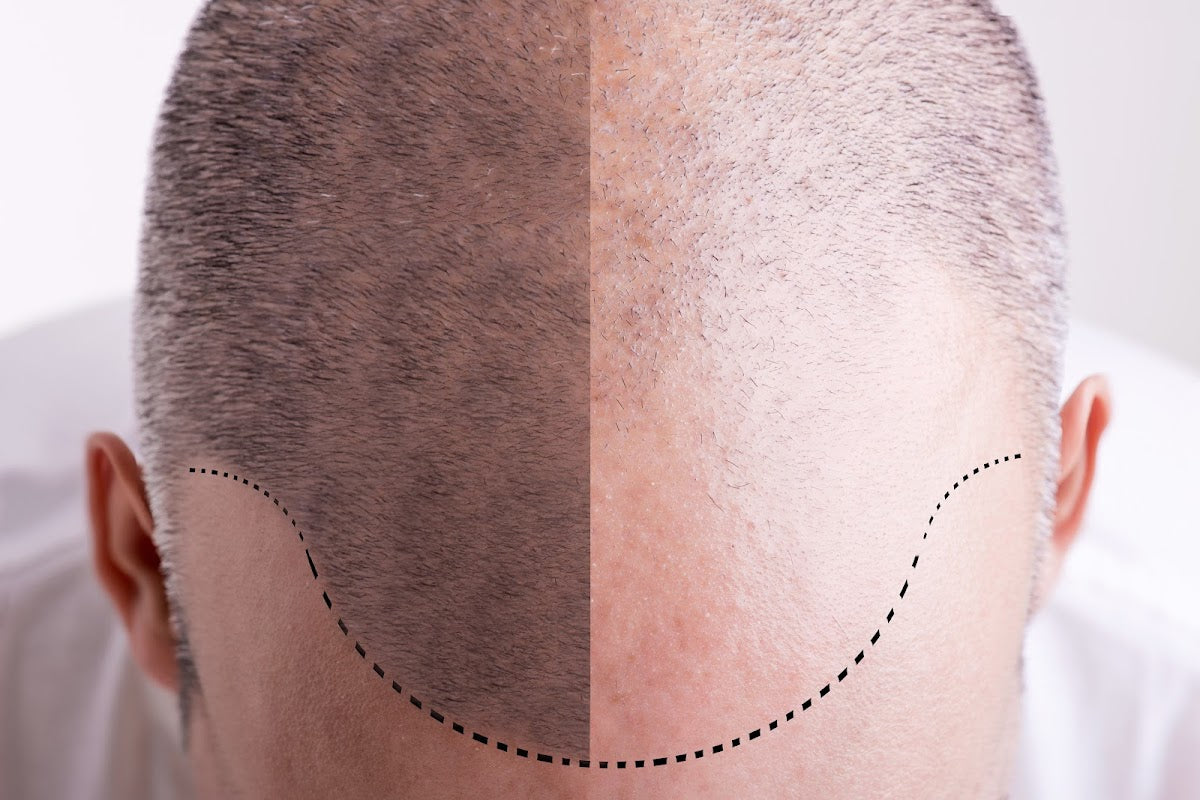 Prime Line OKC | Hair Transplant | Oklahoma City, OK