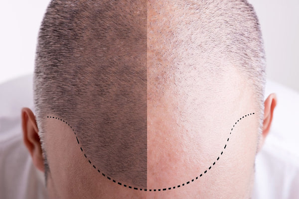 Prime Line OKC | Hair Transplant | Oklahoma City, OK