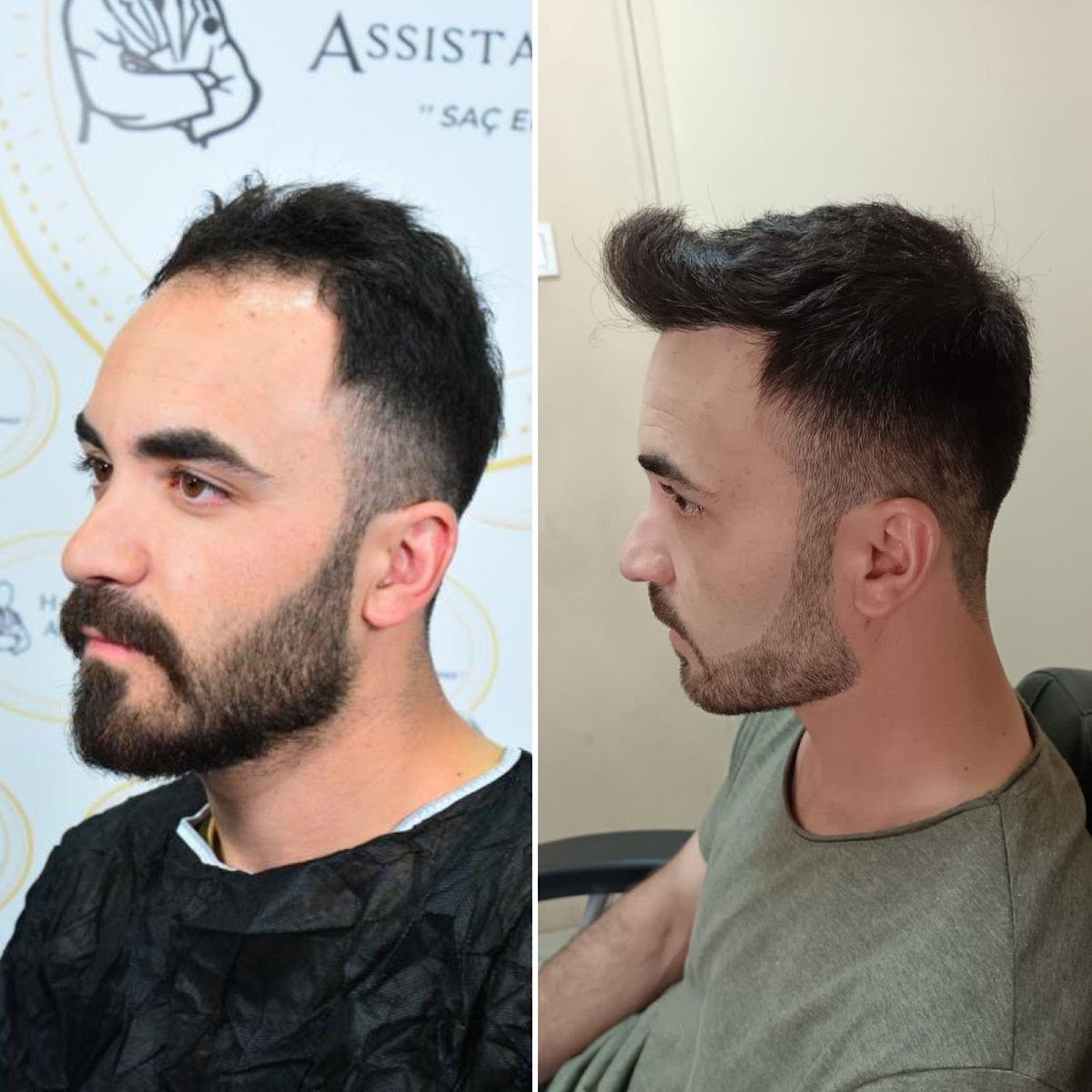 Hasan Demir Saç Ekimi Ankara — Dr.Visor photo 2