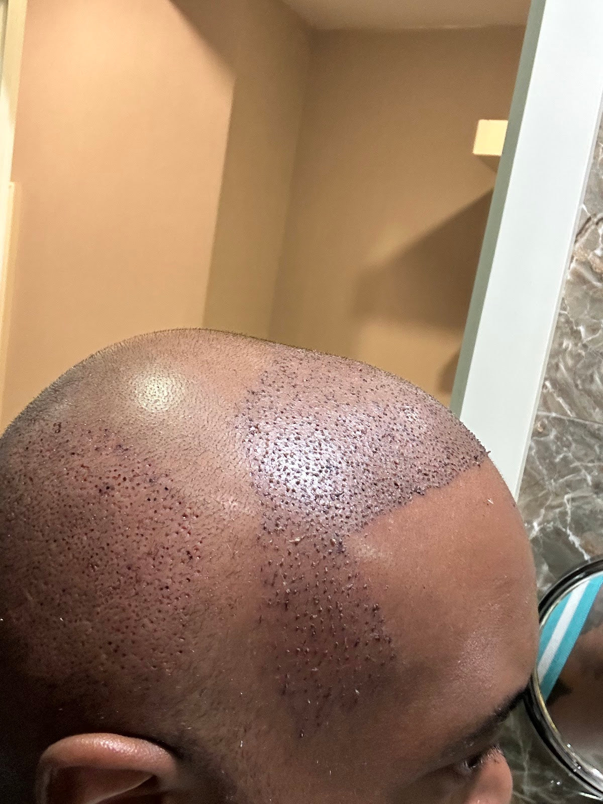 Hair in istanbul | Hair Transplant in Turkey — Dr.Visor photo 5