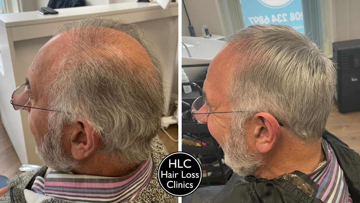Leeds Hair Loss Clinic — photo 5
