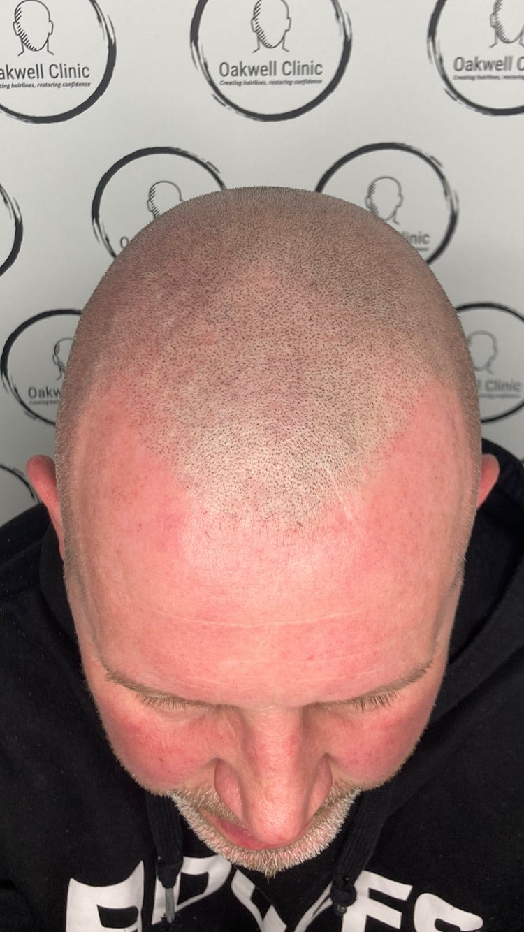 Oakwell SMP Clinic - Hair Transplant clinic in Pudsey, United Kingdom