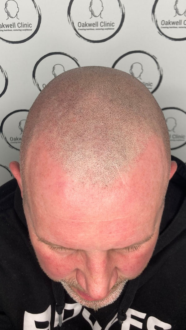 Oakwell SMP Clinic | Hair Transplant | Pudsey