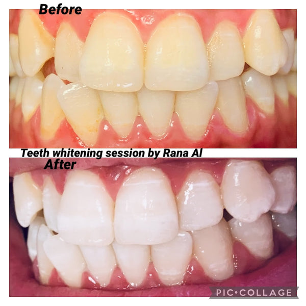 Zoom smile-Rana clinic-Teeth Whitening-Lasers-PRP | Dental | Biddeford, ME