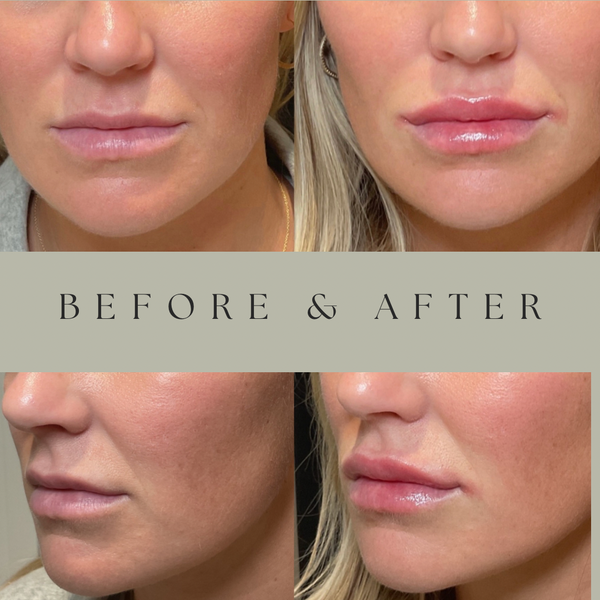 Aesthetics | Hair Transplant | Hurstbourne, KY