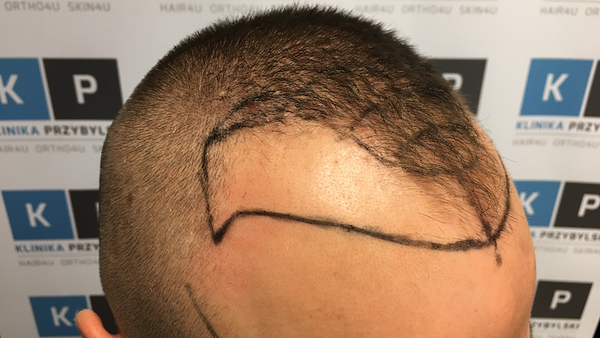 BHR Clinic Poland | Hair Transplant | 62-800 Kalisz