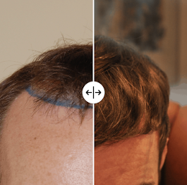 Wimpole Hair Transplant Clinic Leeds — photo 5