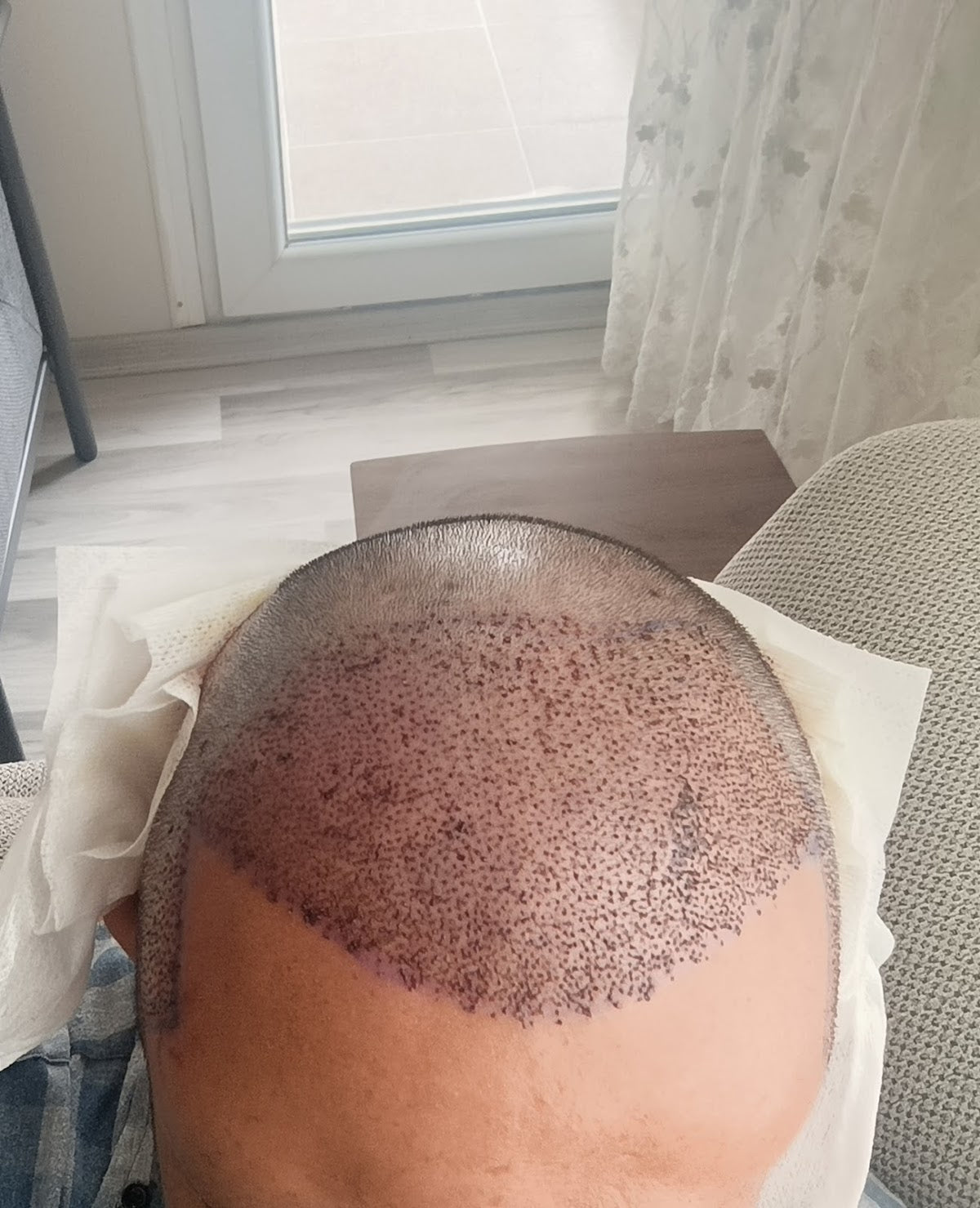 İzmir saç ekim merkezi maxhairclinic / maxhairizmir/saç ekim İzmir — Dr.Visor photo 4