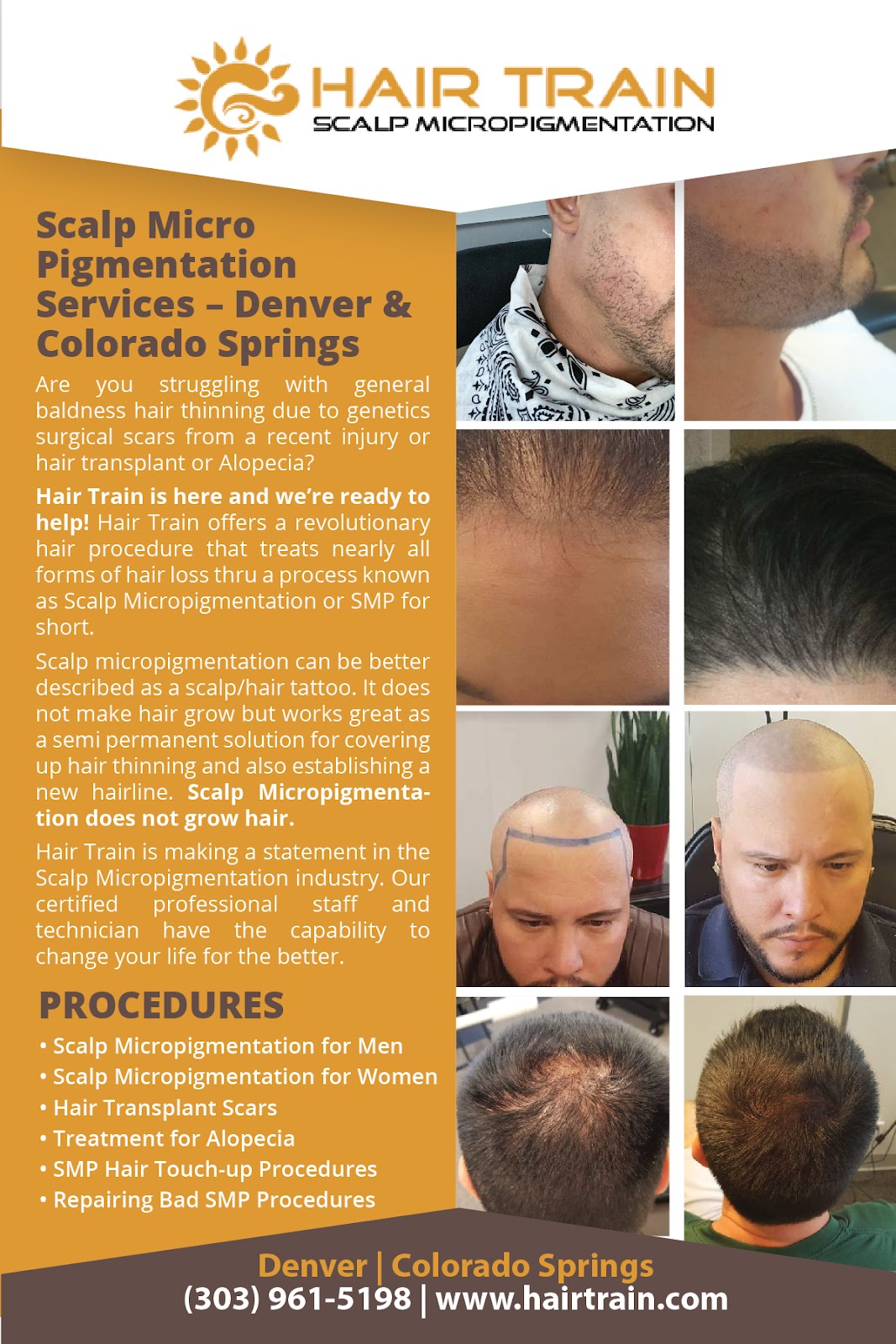 Hair Train Scalp Micropigmentation | Hair Transplant | Colorado Springs, CO