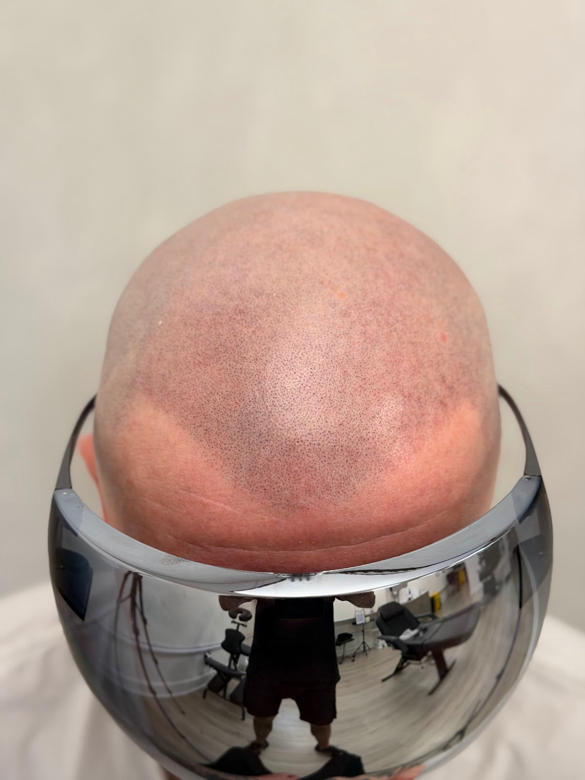 DC Scalp Micro - Hair Transplant clinic in Glasgow, United Kingdom