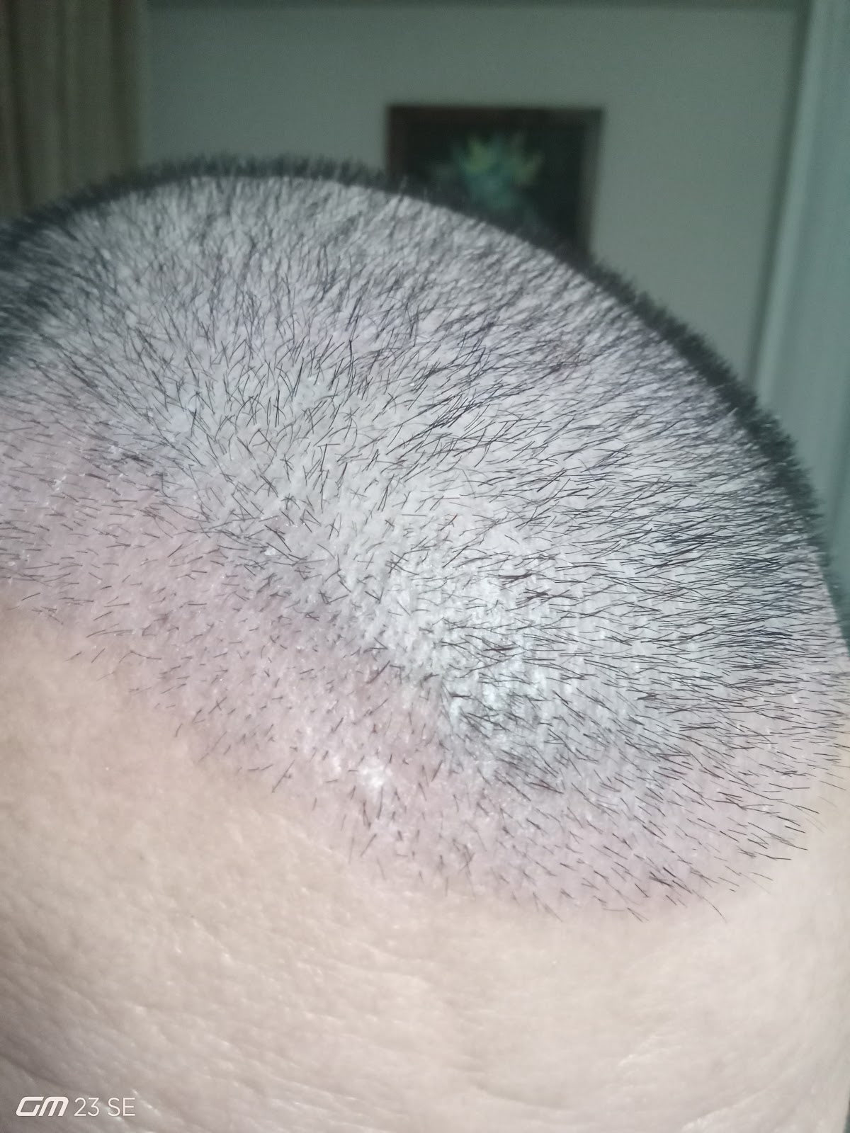 One Hair Clinic Transplantation - Plastic Esthetic — Dr.Visor photo 5