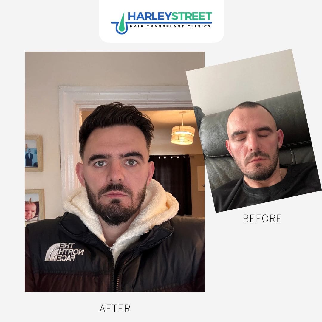 Hair Transplant Leeds — photo 5