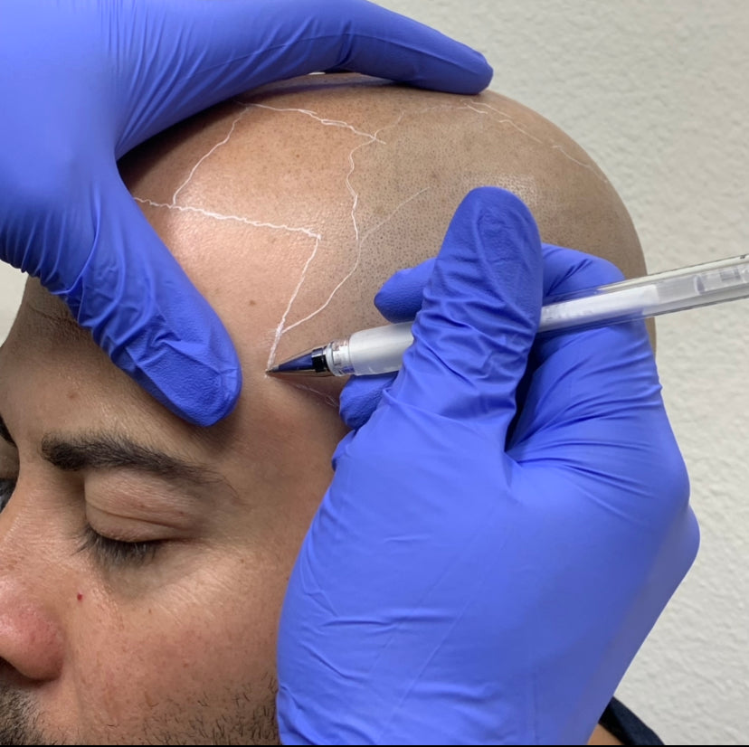 Scalp Theory KC | Hair Transplant | Gladstone, MO