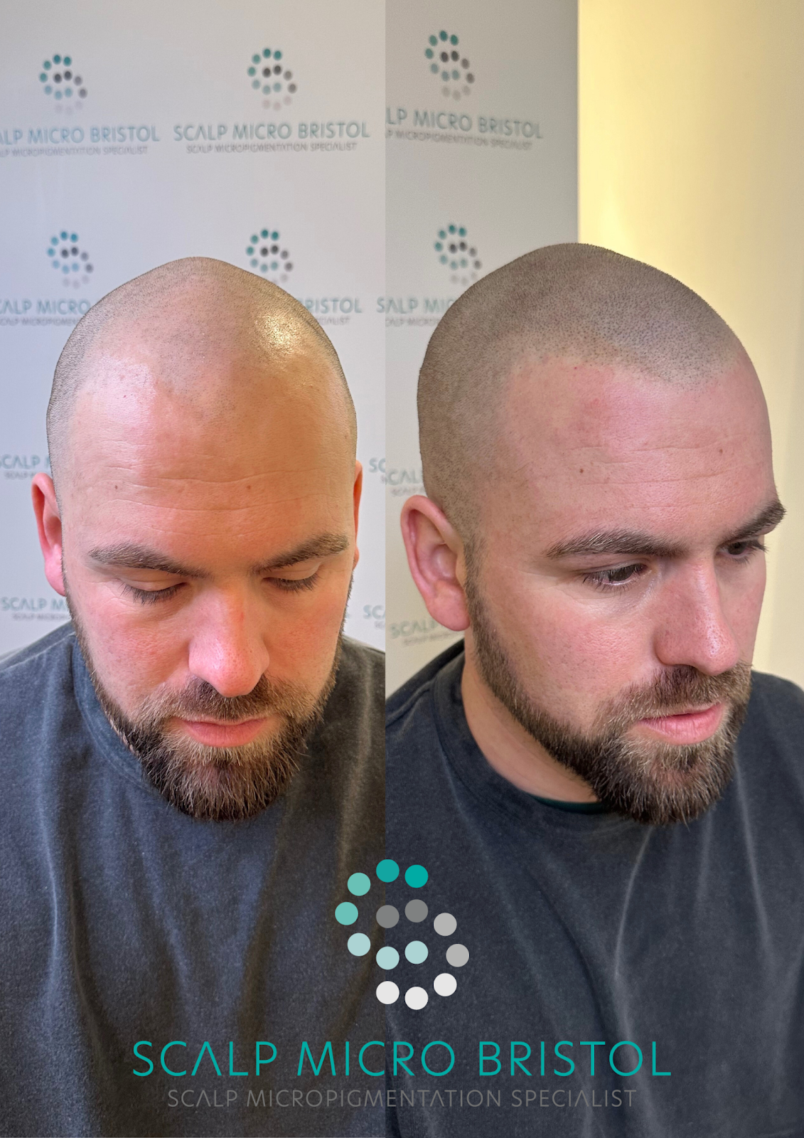 Scalp Micro Bristol - Hair Transplant clinic in Bristol, United Kingdom