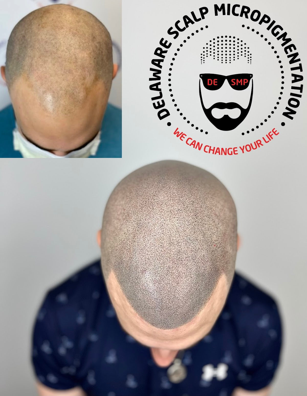 Scalp Micropigmentation | Hair Transplant | Wilmington, DE