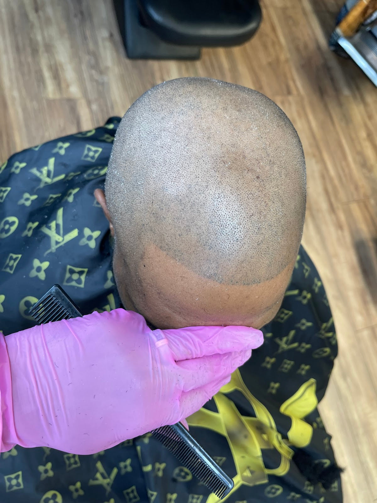 Smp Energy by Damon | Hair Transplant | Baltimore, MD