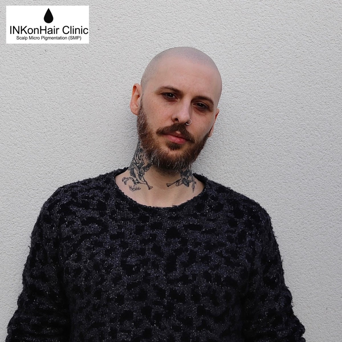 INKonHair Clinic - Hair Transplant clinic in Bristol, United Kingdom
