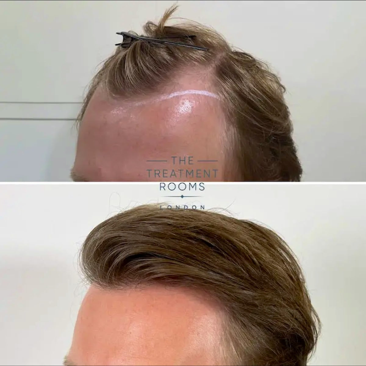 The Treatment Rooms London - Hair Transplant clinic in London SW15 1AZ, United Kingdom