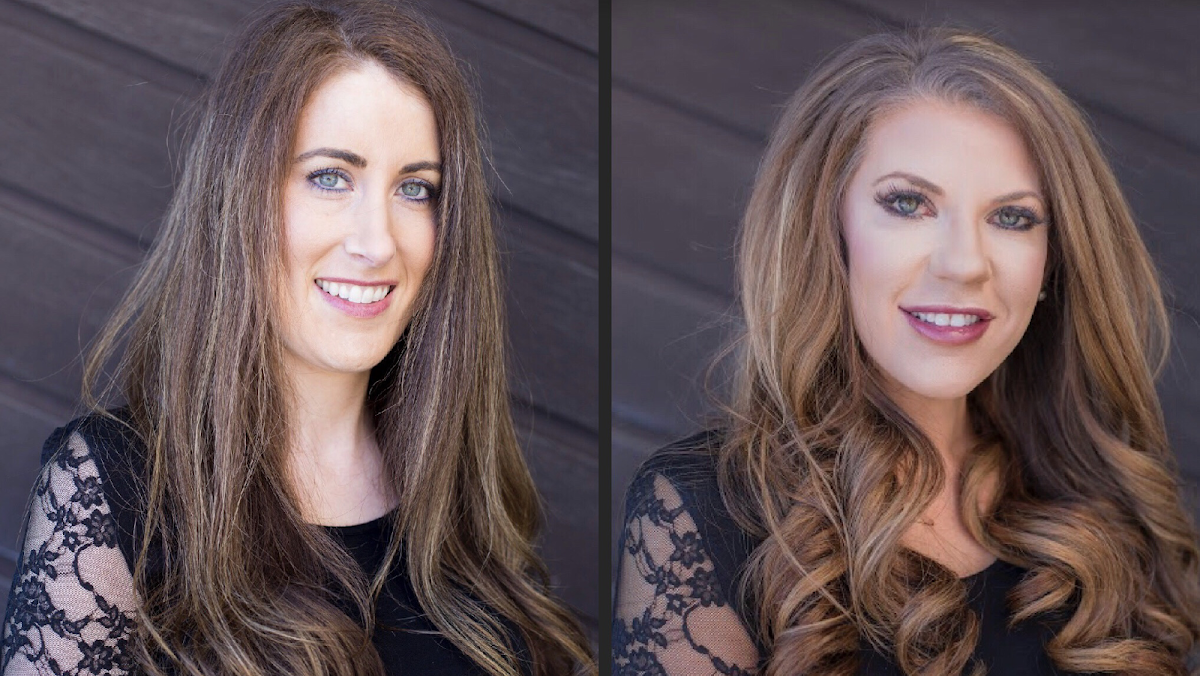 Allure Aesthetics | Hair Transplant | Great Falls, MT