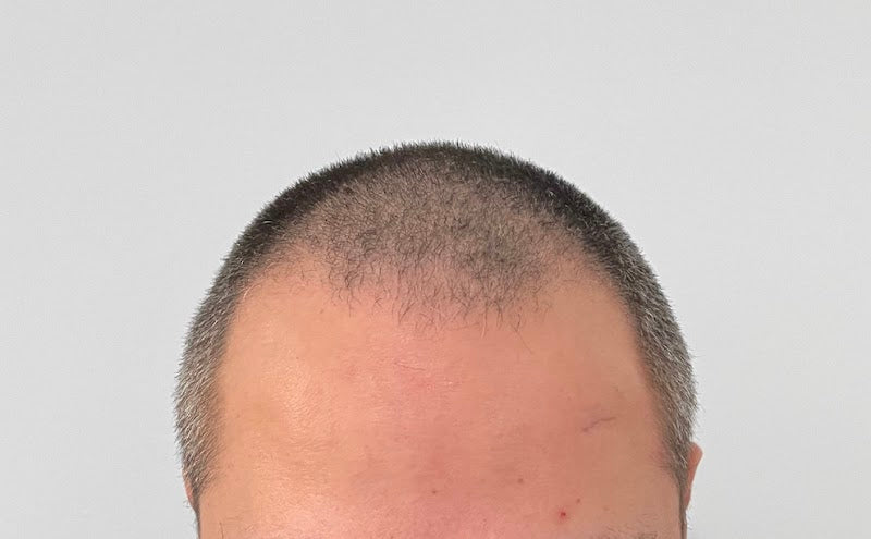 Hair TP Clinic | Hair Transplant | 411 34 Göteborg